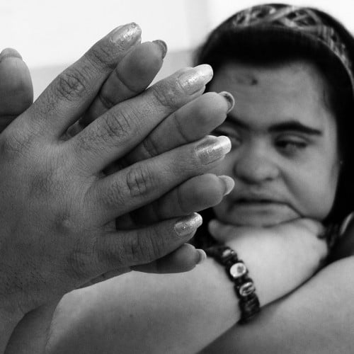 Imagen sindrome de down